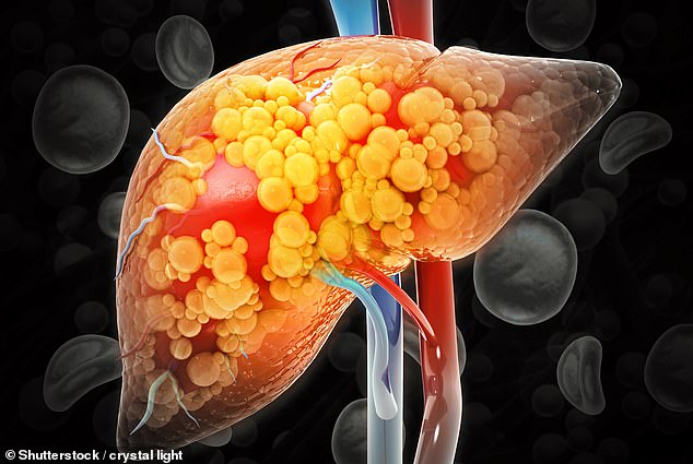 Known medically as metabolic dysfunction-associated steatotic liver disease (MASLD), the condition is not linked to heavy drinking¿the more commonly known cause of liver problems