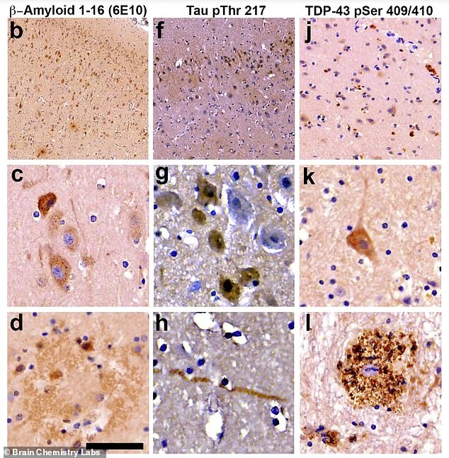 Scientists found the hallmarks of Alzheimer's in the brains of all the dolphins tested, including misfolded tau proteins (center), amyloid plaques (left) and tangled fibers (right) that destroy neural connections
