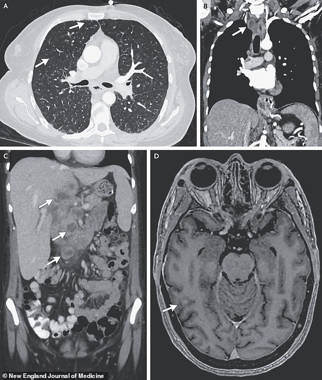 The above scans show nodules in several of the woman's organs. Image A is a scan of her lungs, with arrows pointing toward the nodules. Image B shows an arrow pointing toward an enlarged lymph node. Image C shows arrows drawing attention to nodules in the liver and head of the pancreas, and Image D shows a nodule in the woman's brain