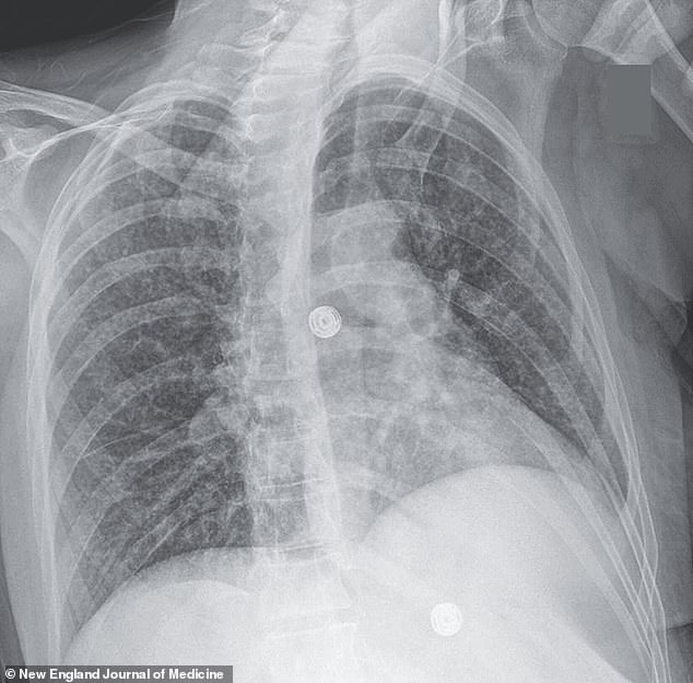The above x-ray scan shows nodules in the woman's lungs from tuberculosis