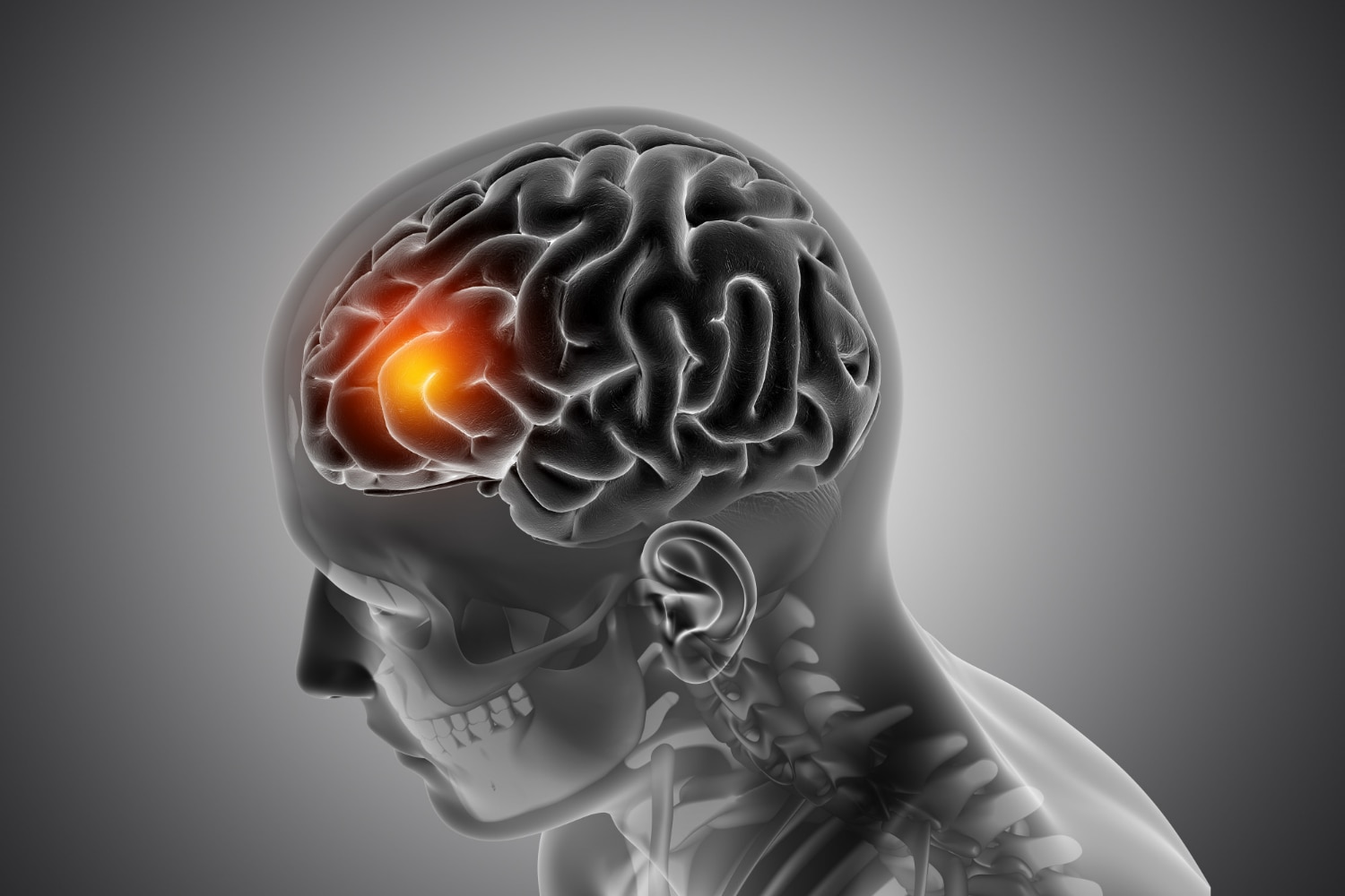 Recognising stroke symptoms early can prevent long-term disability.(Freepik) Recognising stroke symptoms early can prevent long-term disability.(Freepik)