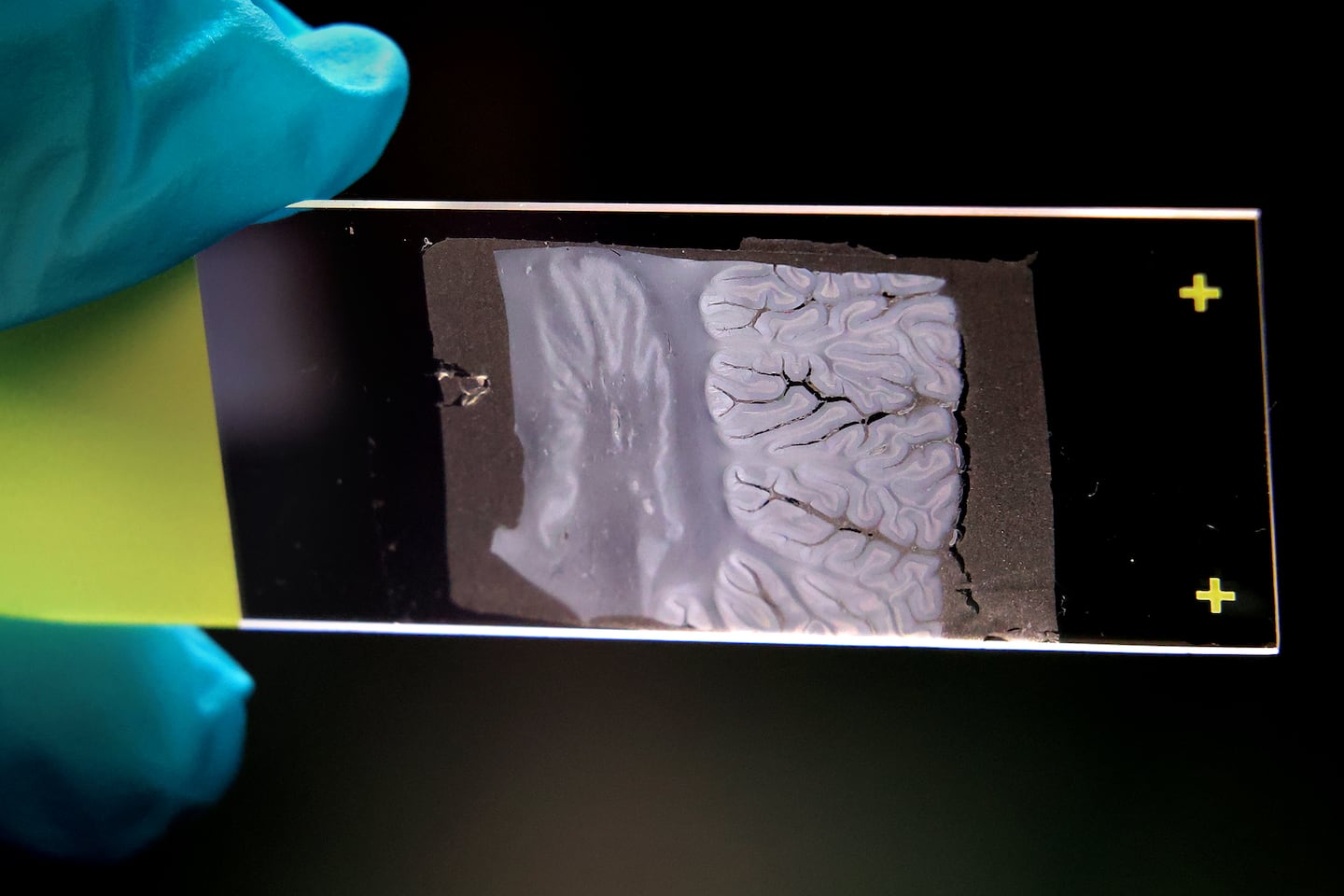 Histopathology lab manager Myrtha Constant held a brain tissue sample just 5 microns thick.
