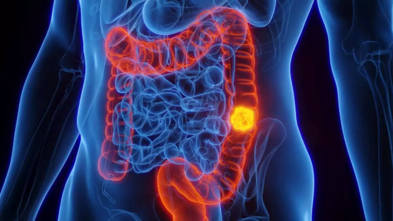 Image credits: Getty Images A shocking symptom of colon cancer