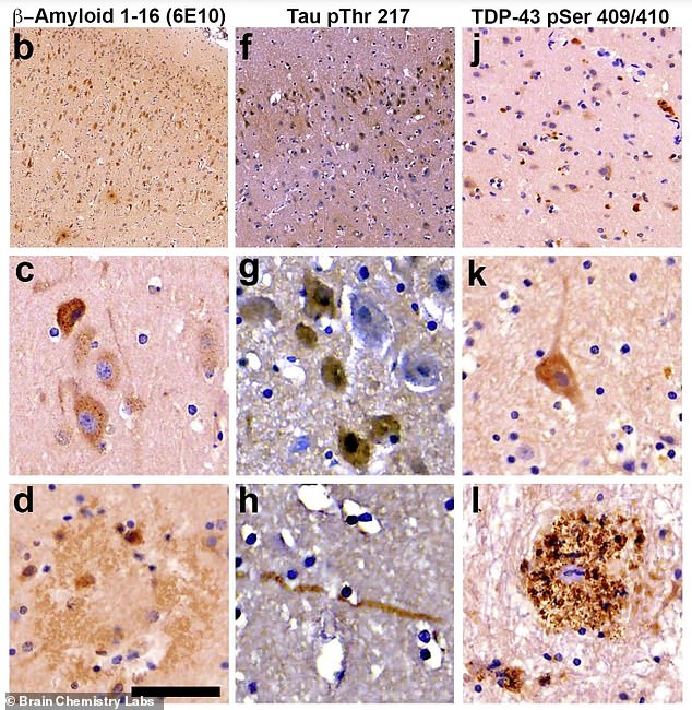 Scientists found the hallmarks of Alzheimer's in the brains of all the dolphins tested, including misfolded tau proteins (center), amyloid plaques (left) and tangled fibers (right) that destroy neural connections