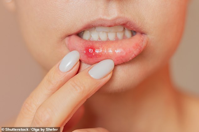  ‘My mouth ulcers keep coming back – what can I do?’ DR ELLIE reveals the triggers, from three common foods to an item in everyone’s bathroom – and the serious, lifelong disease they can be a symptom of