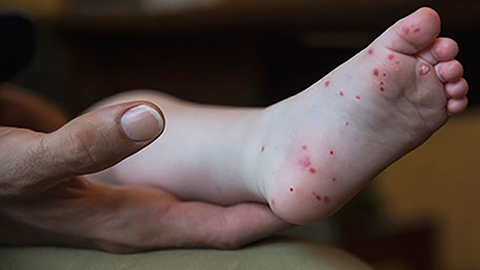  Hand, foot and mouth disease on rise in certain areas: Doctor explains symptoms, if it’s contagious, risk for adults and kids