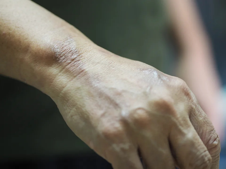 Close-up of a person's hand showing dry skin, highlighting texture and care concerns