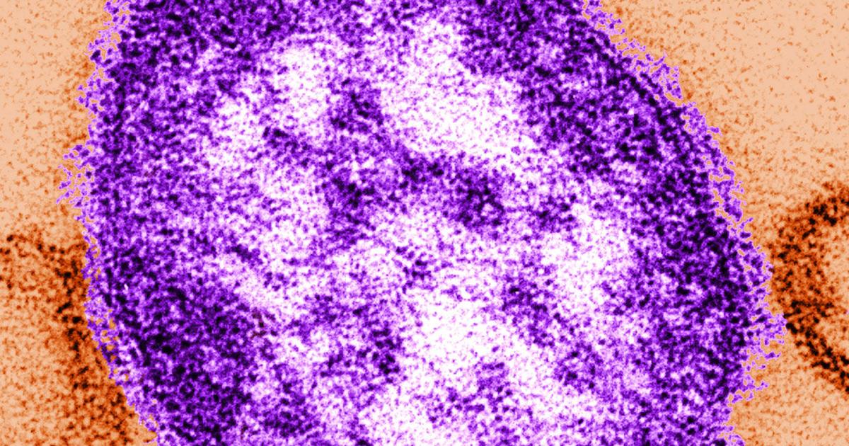  Possible measles exposure reported at Phila. International Airport | Southeastern Pennsylvania