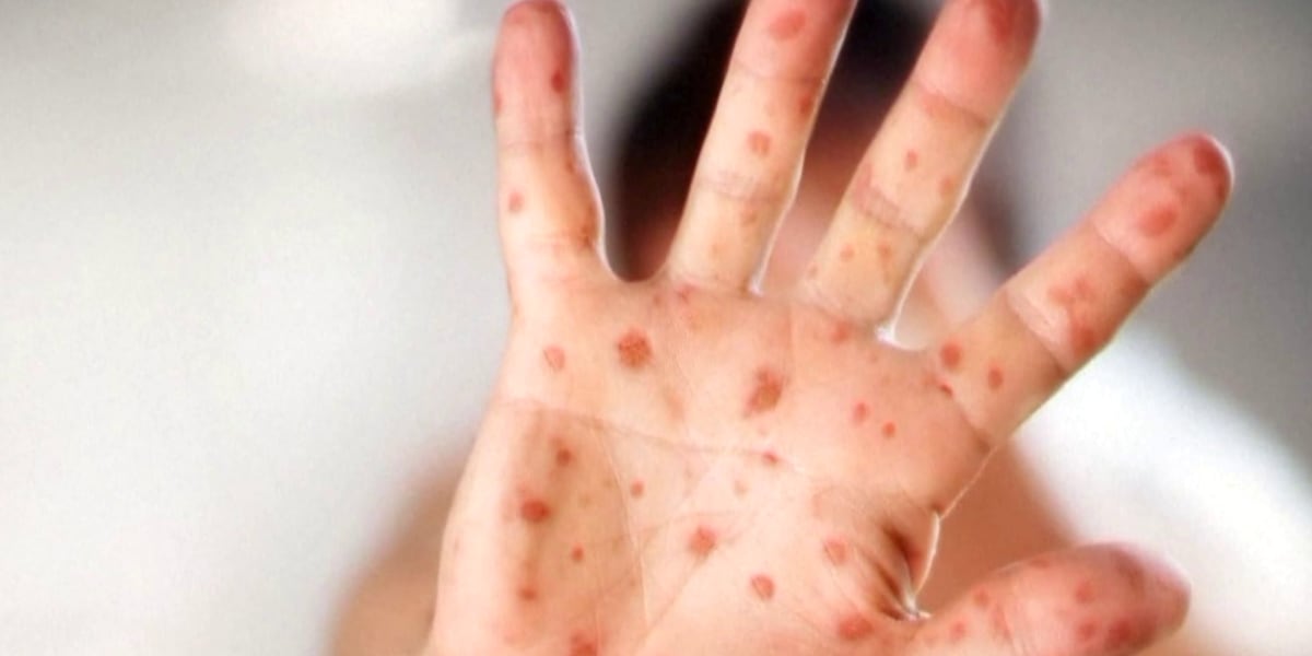  Measles exposure confirmed at GSP airport and Upstate church