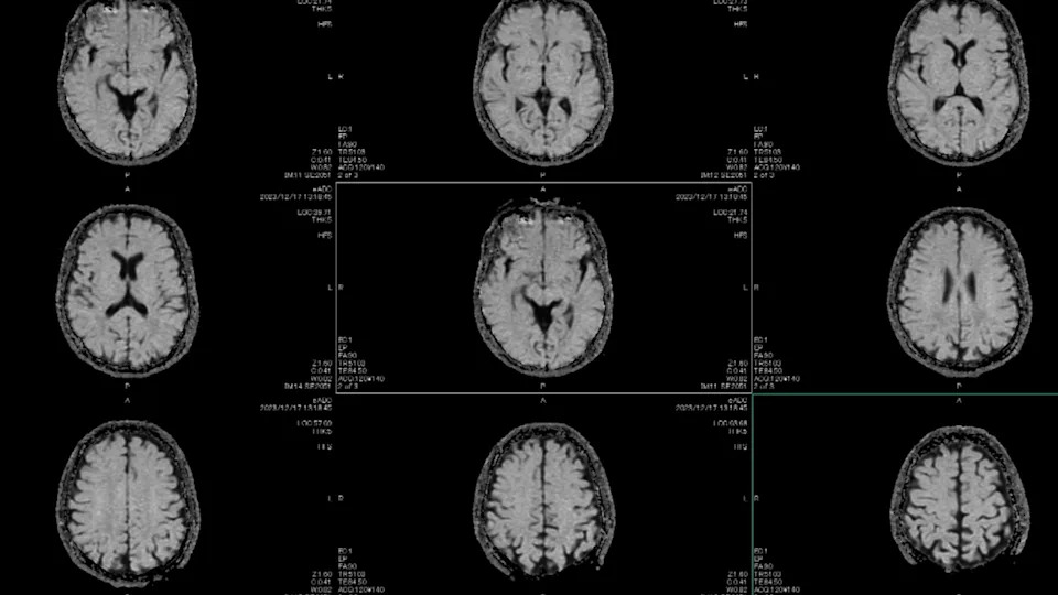 MRI brain scans showing multiple cross-sectional images, detailing the brain's structure in a clinical setting