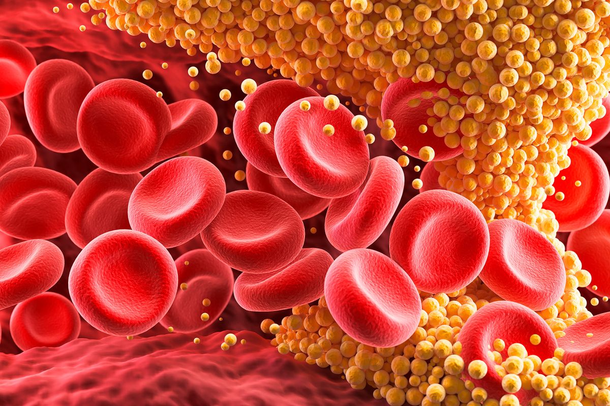  A new one-time treatment could wipe out high cholesterol forever