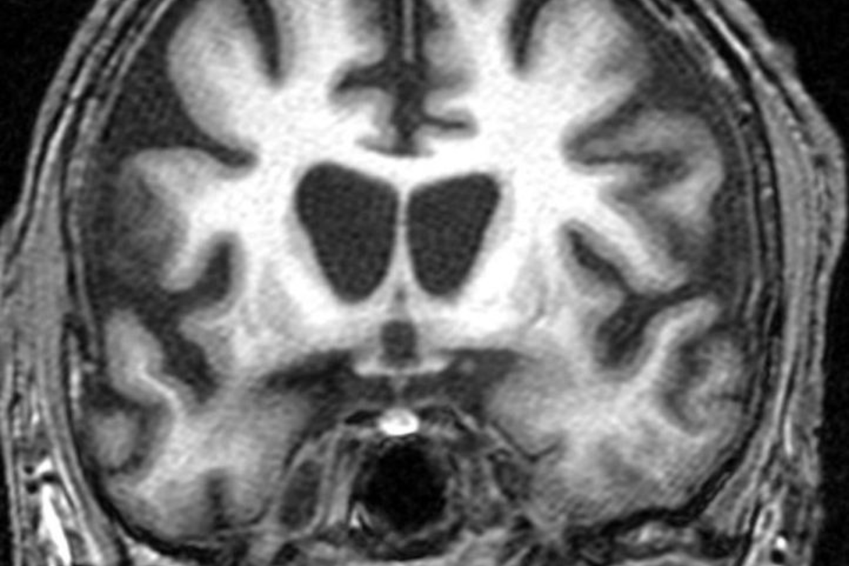  Gene Therapy Aims To Slow Huntington’s Disease To A Crawl