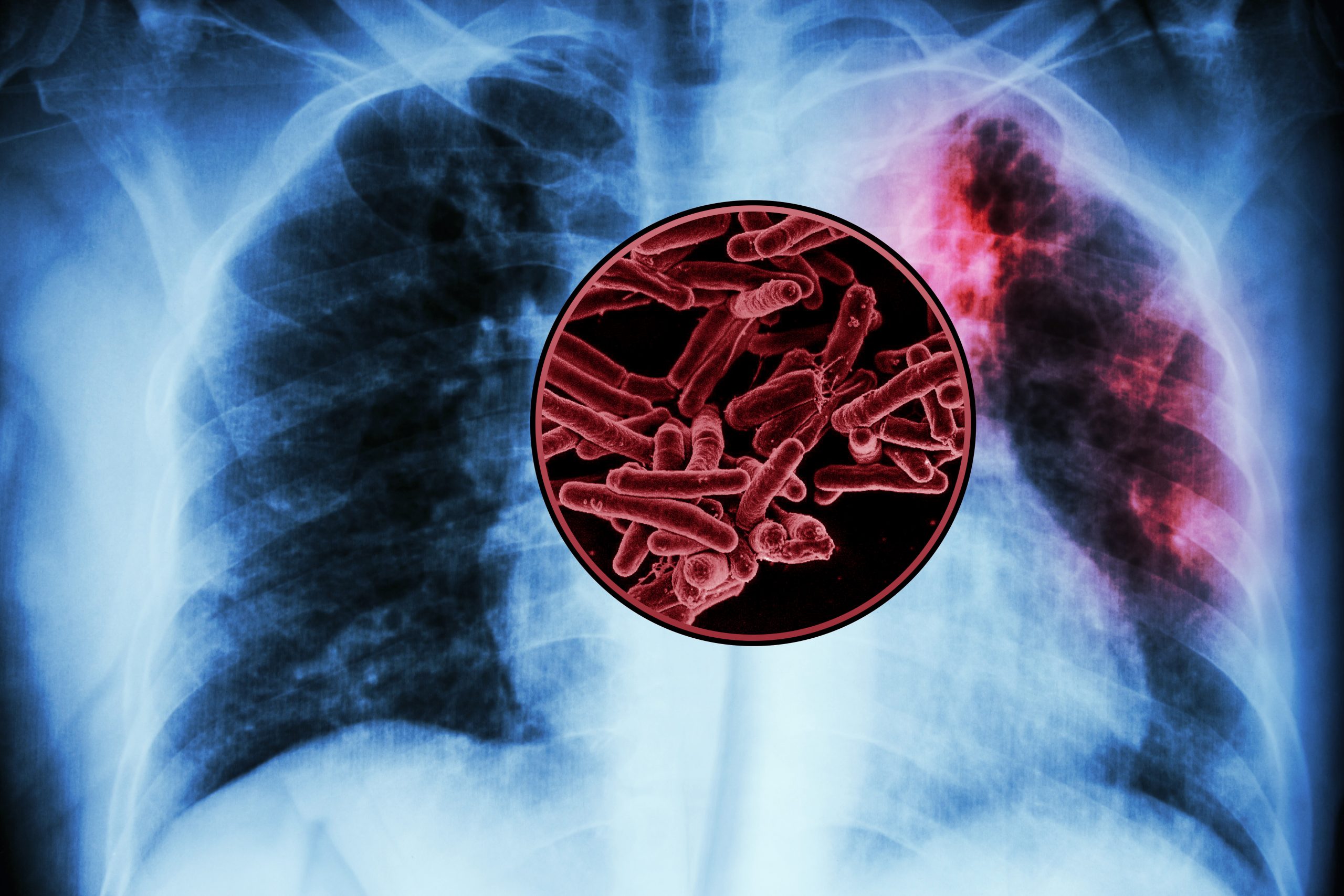 MIT study finds targets for a new tuberculosis vaccine | MIT News