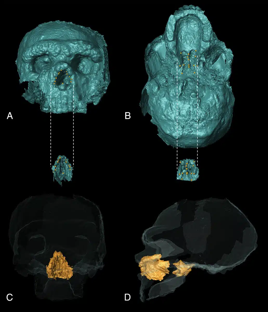 Phases Involved In The Reconstruction Of The Altamura Nasal Cavity