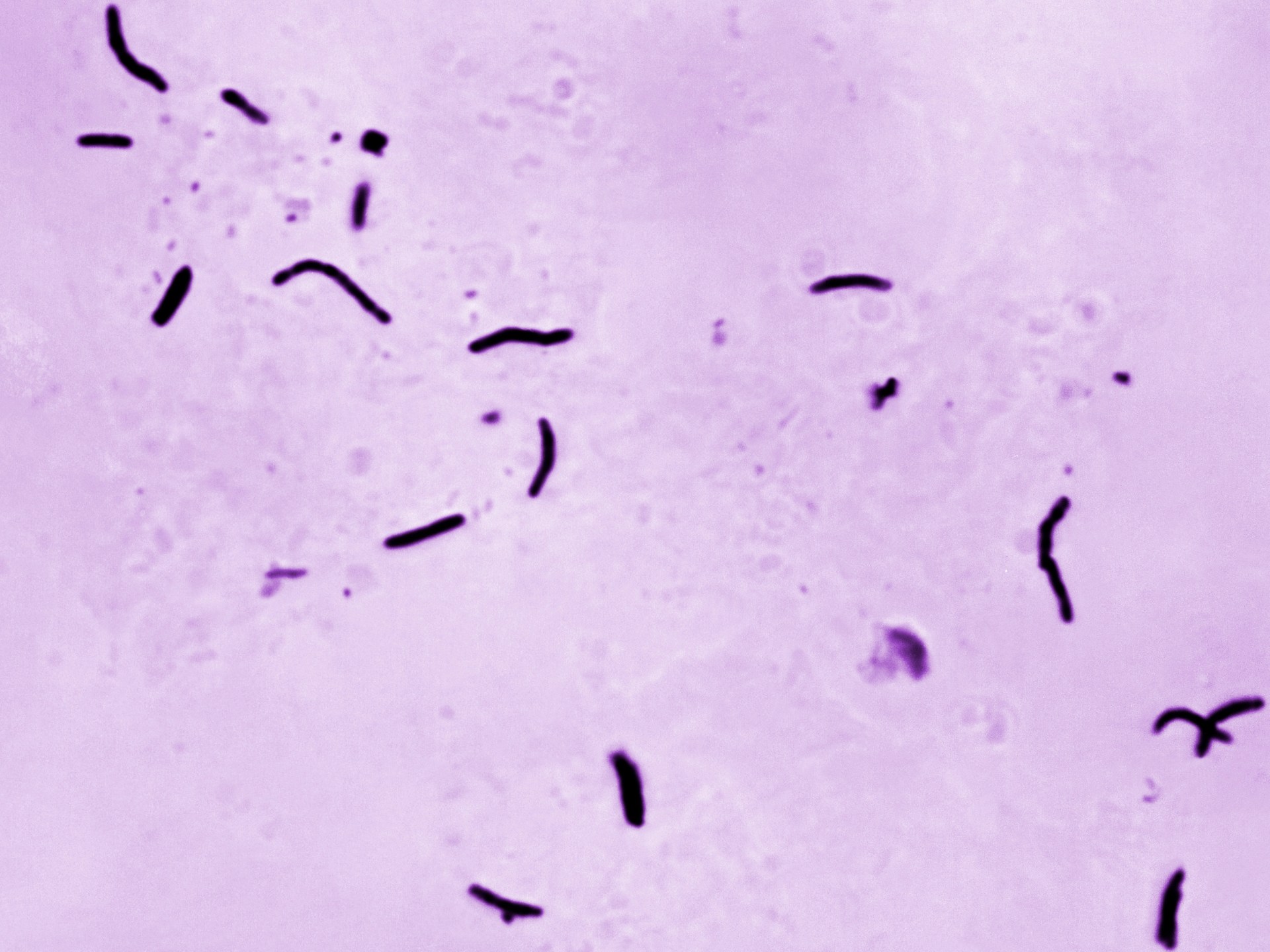  Tuberculosis kills 1.23 million people last year, WHO says | World Health Organization News