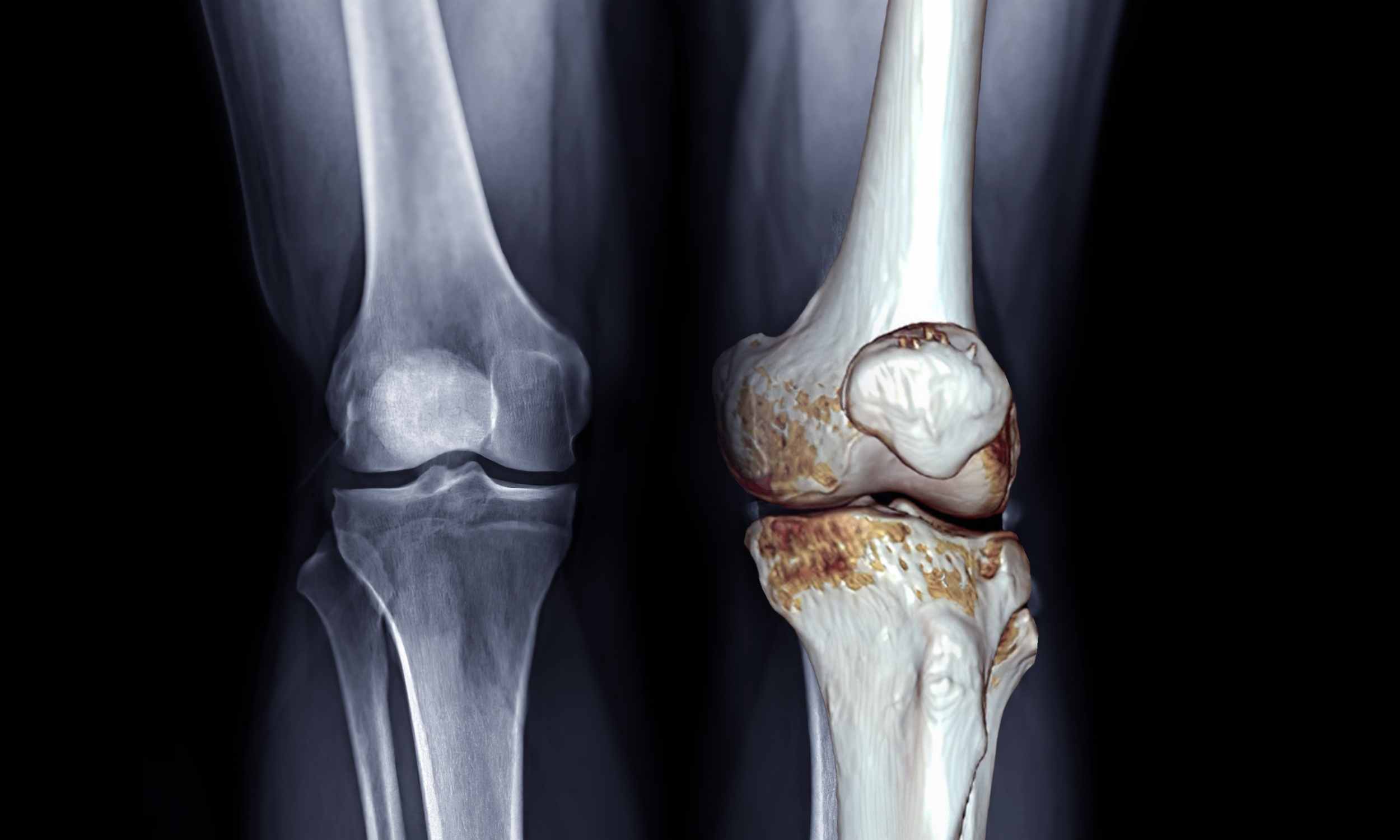  Medications are not the best treatments for osteoarthritis
