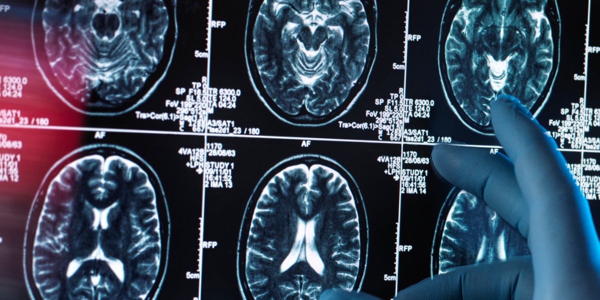  Researchers Have Discovered 2 New Dementia Risk Factors. Here’s What They Are.