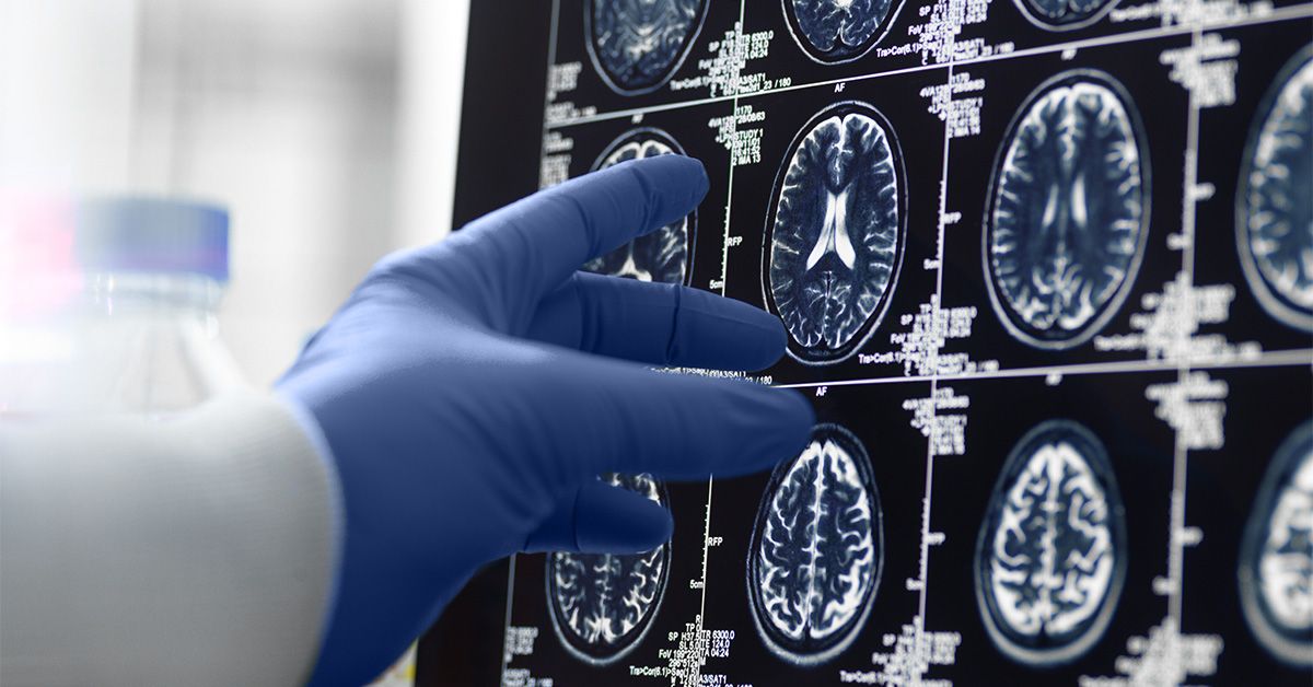  Neurovascular, metabolic changes may predict progression