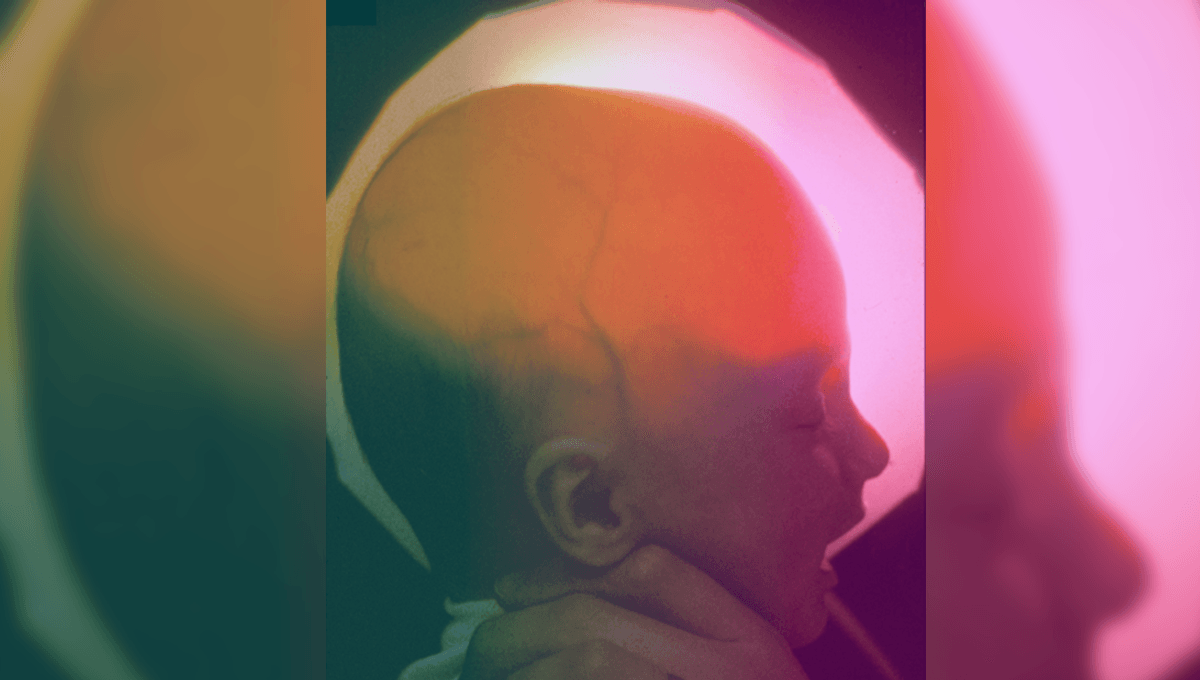  A Woman With Hydranencephaly Just Celebrated Her 20th Birthday. What Does That Mean?