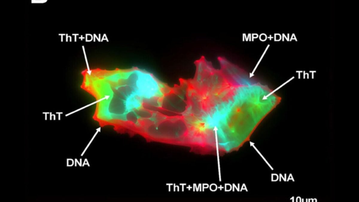  People With Long Covid Have This Freaky-Looking Thing in Their Blood