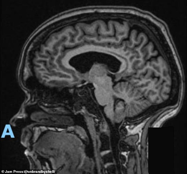 That crisis finally led to a neurology referral and the MRI that revealed a 4mm Chiari malformation, pictured here