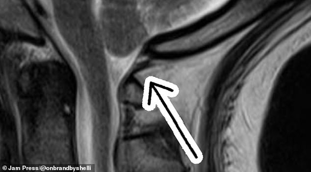 Chiari malformation, which is a rare condition impacting around 300,000 Americans, causes the lower part of the brain to push down into the spinal canal