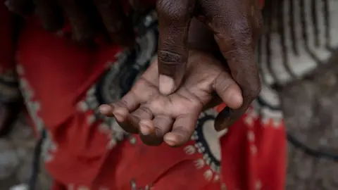 Getty Images A child's hand is face up with the thumb of an older person's hand pressing into it. A red cloth is out of focus behind the hands.