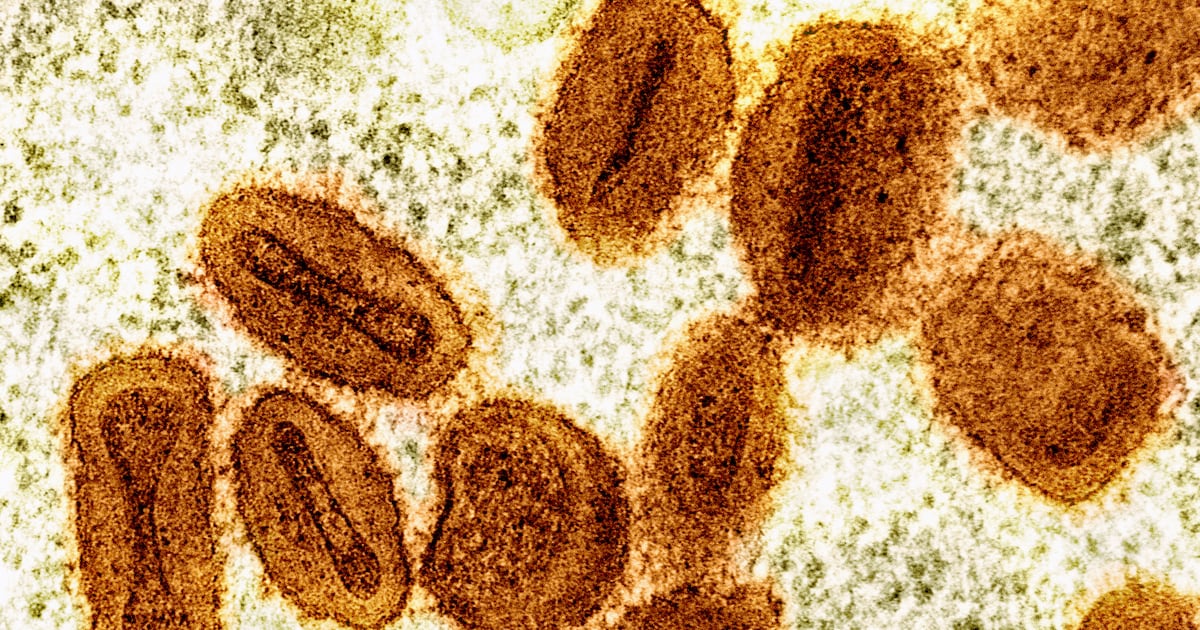  Health officials confirm mpox in Anchorage adult who traveled out of state