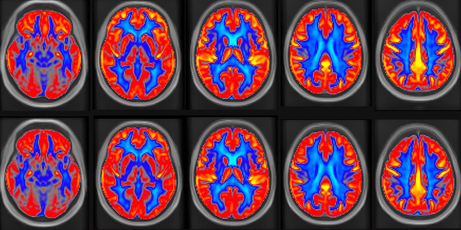  This common snack enhanced memory and brain vascular function in a 16-week trial