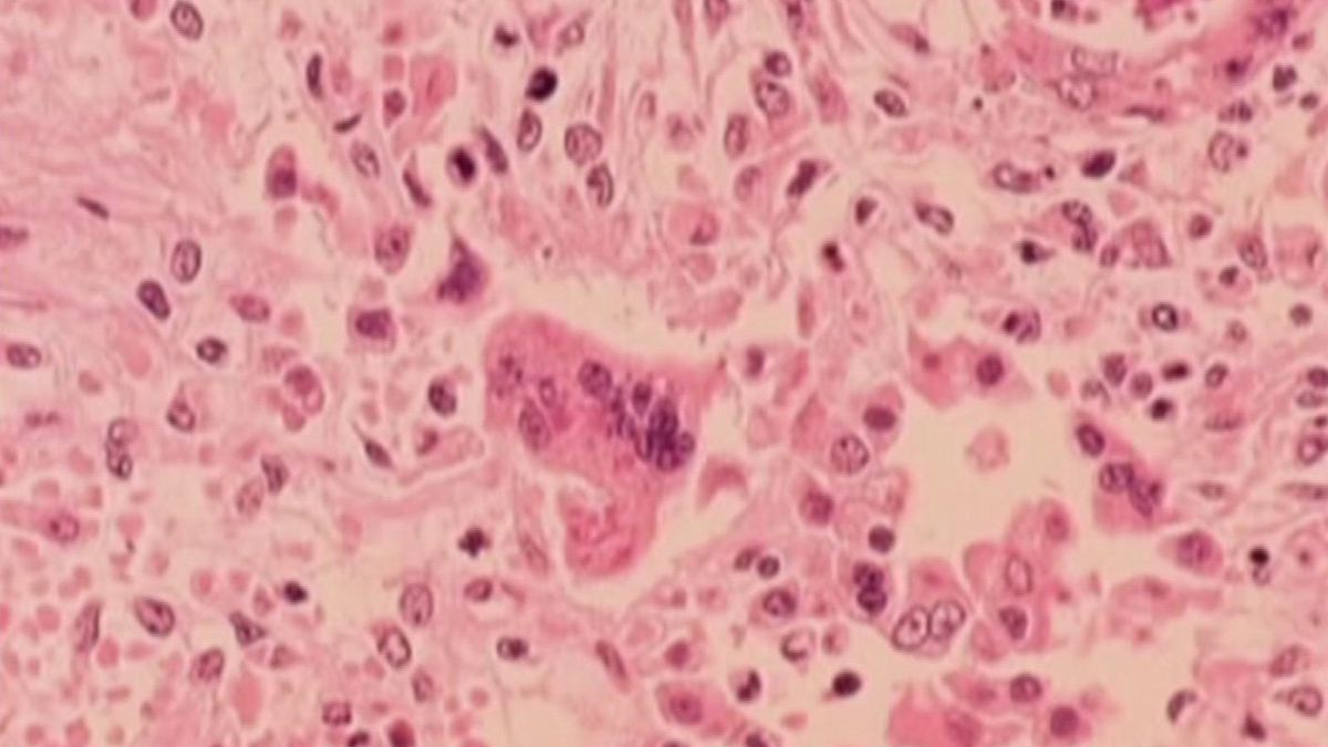 First measles case in Connecticut in over four years – NBC Connecticut