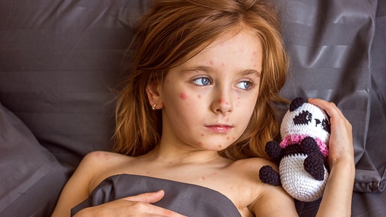 Measles cases are on rise in United States.(Adobe Stock)