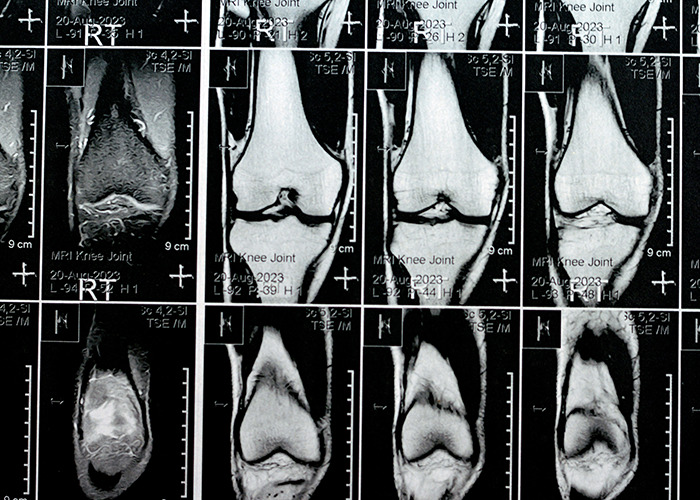 MRI scans showing detailed images of knee bone tissue, related to microplastics discovery and expert research responses.