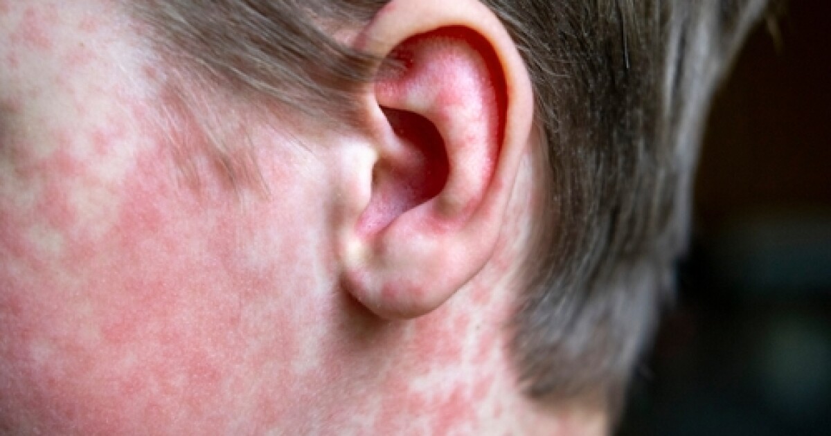  Measles case confirmed through Sky Harbor, officials notifying those exposed