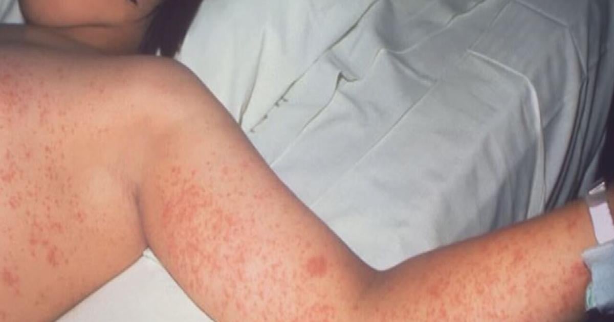  Measles exposure detected in Kentucky after unvaccinated traveler visits Ark Encounter | Local News