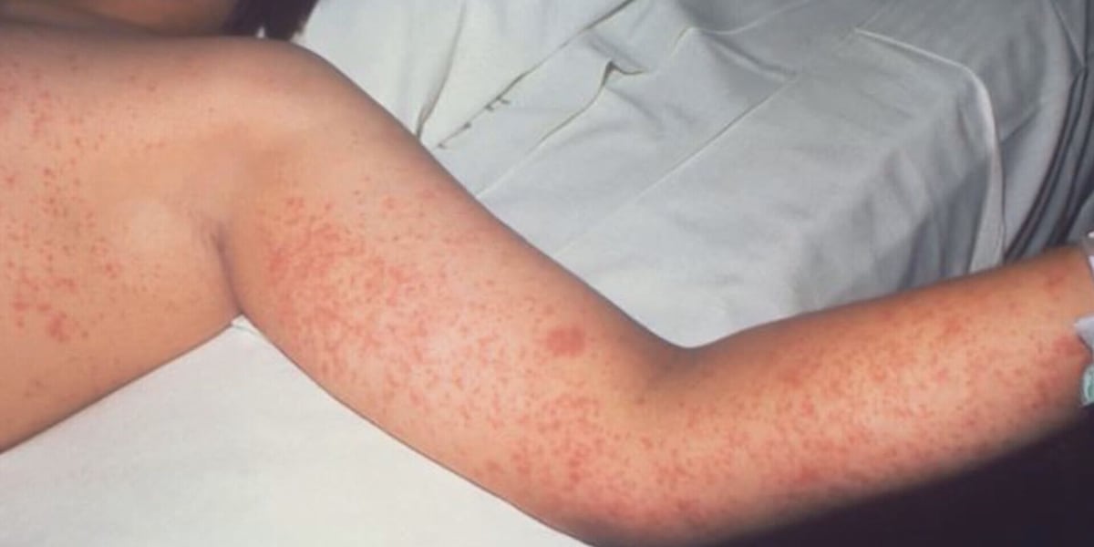 Possible measles exposure at NKY hotel, attraction