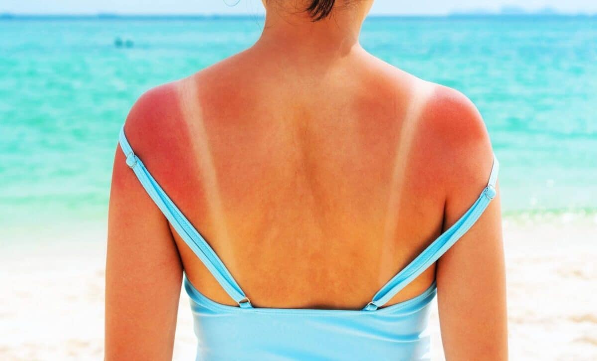  Main Cause of Sunburn Finally Revealed, and It’s Not the Reason We’ve Always Believed