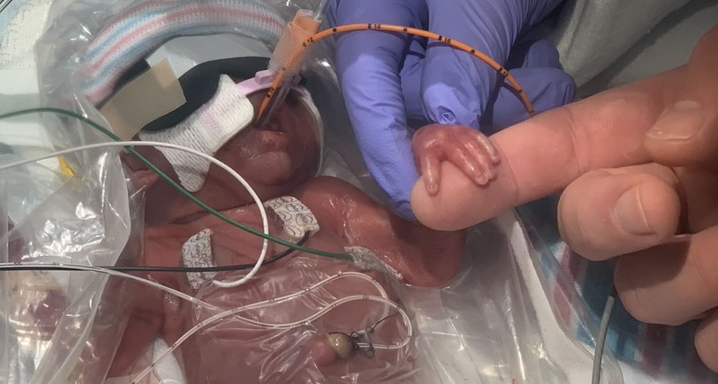 Tiny Baby Born With Hands Smaller Than a Fingertip is Now Home After a Year–And Developing Normally