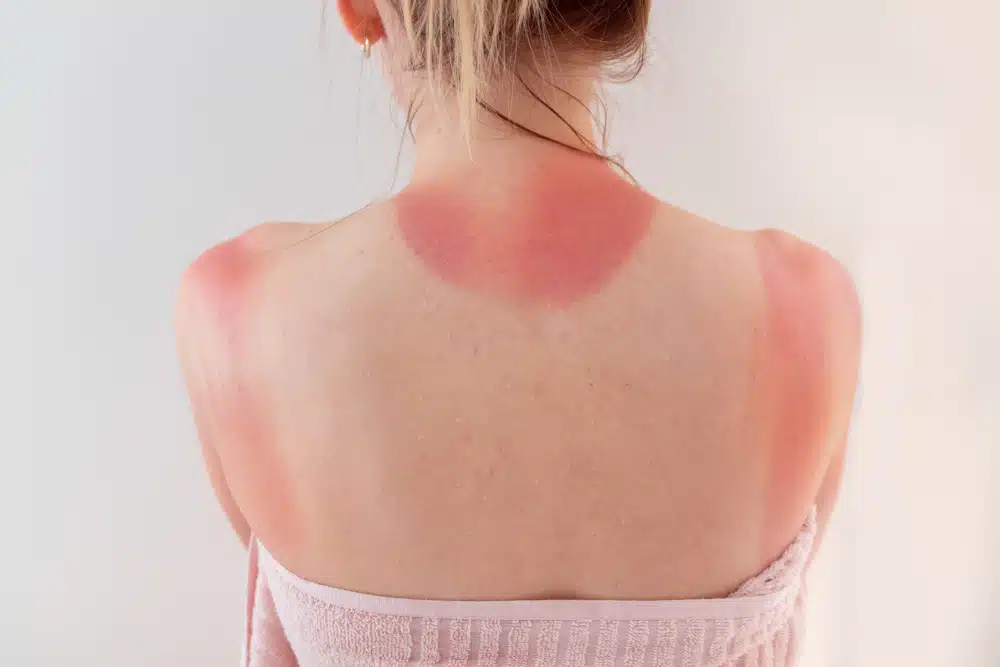 Woman's,back,skin,hurt,from,sun,burn.,burn,from,the