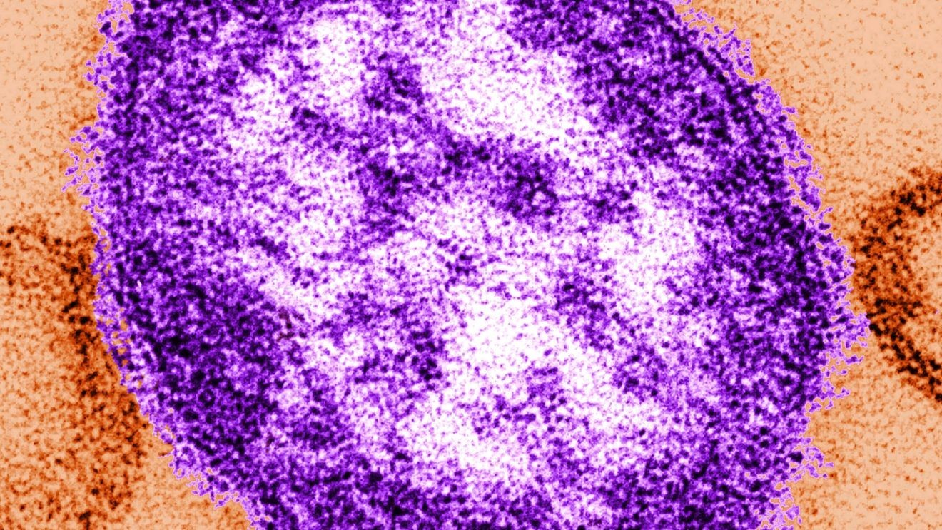  Measles outbreak declared in Snohomish County as 3 local children test positive
