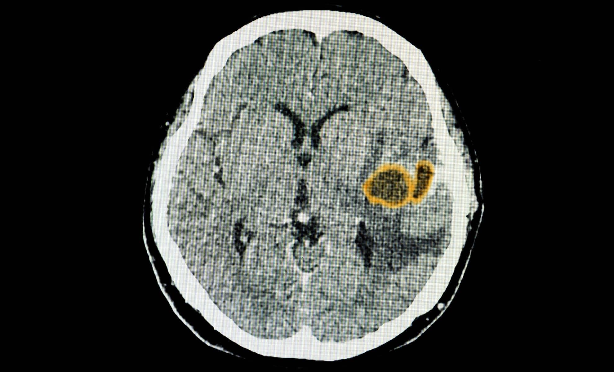  Brain Parasite Hijacks Immune Cells, and Uses Them to Survive