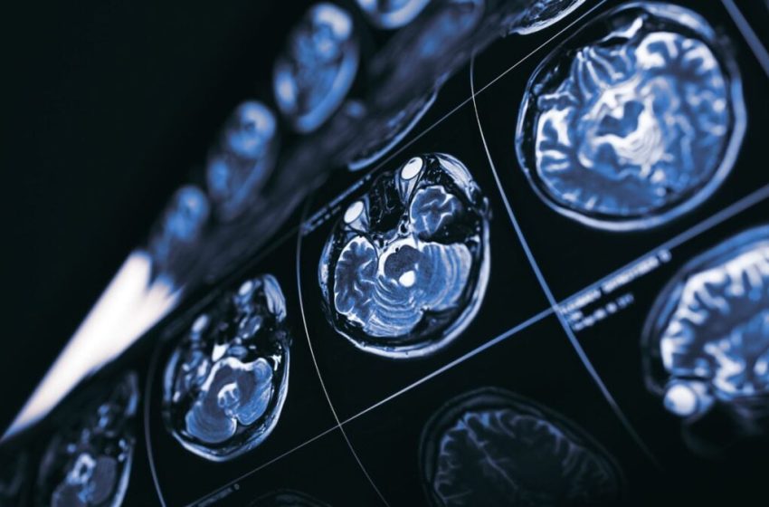  What If Cancer Holds the Key to New Treatments for Alzheimer’s Disease?