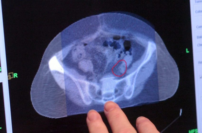  This cancer type is now leading cause of death from the disease for those under 50