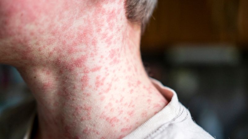  More than 2,000 measles cases reported in the US this year as ongoing outbreaks threaten elimination status
