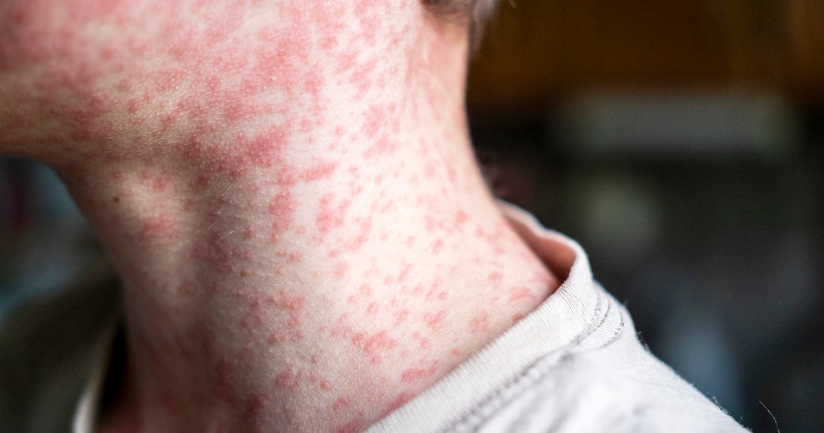  Measles cases surge in South Carolina as U.S. risks losing elimination status