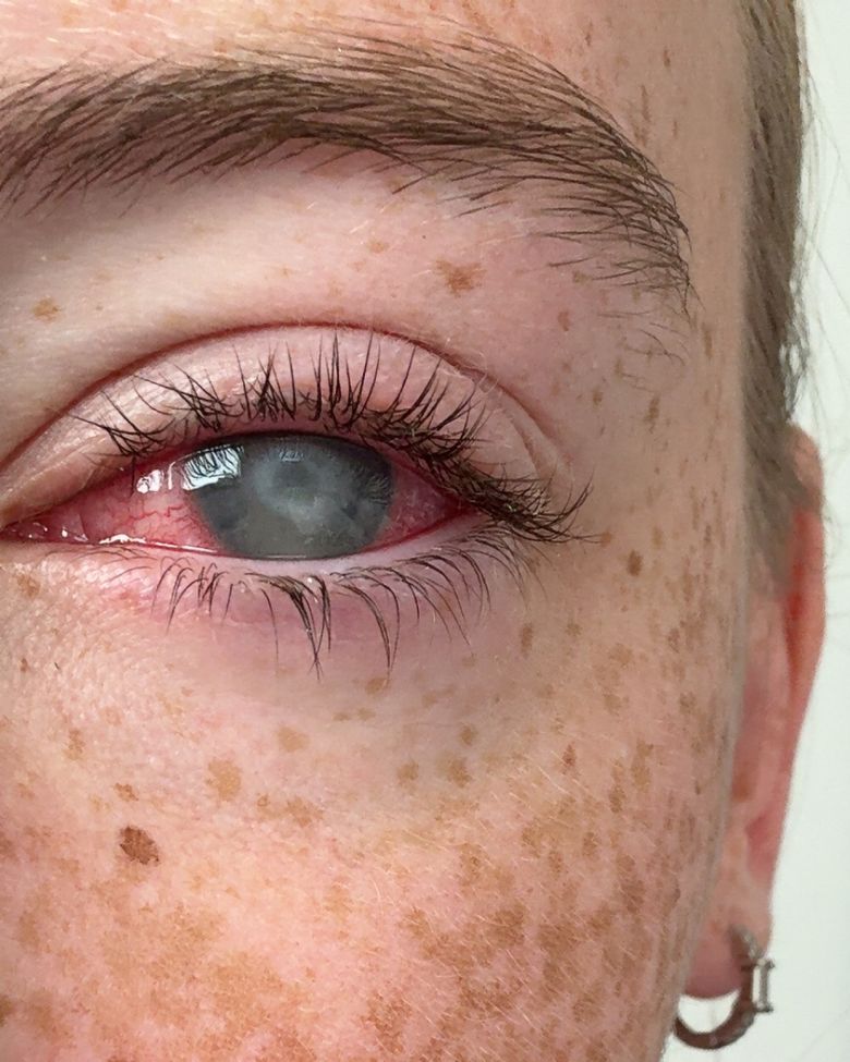 In the same eye, the disease progresses to the point of scarring and clouded vision.