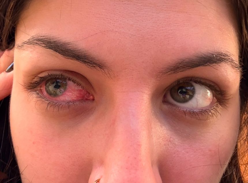 Acanthamoeba keratitis causes redness in Hannah's eye.