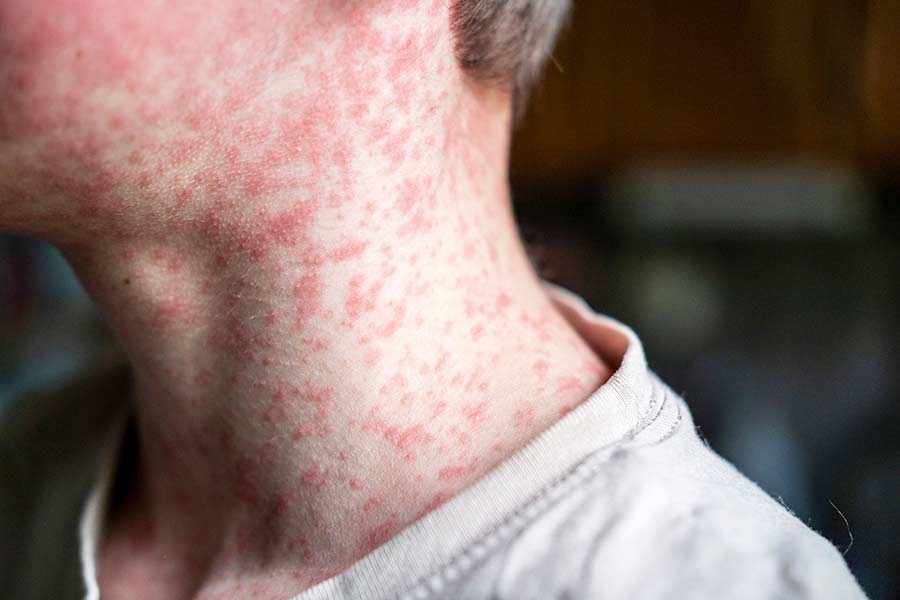  Health officials report first local case of measles for 2026