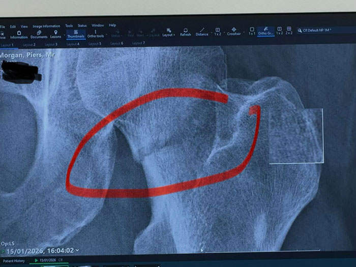 X-ray image showing hip injury with red circle highlighting damage related to Piers Morgan and Donald Trump incident.