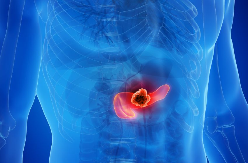  Drug trio found to block tumour resistance in pancreatic cancer