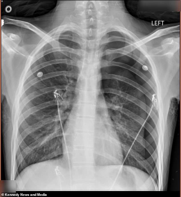Pictured above is the x-ray scan showing Dodge's collapsed left lung. Doctors said that after the second time, he could have died in the hospital lobby